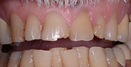 Close up of man with chipped uneven and discolored teeth