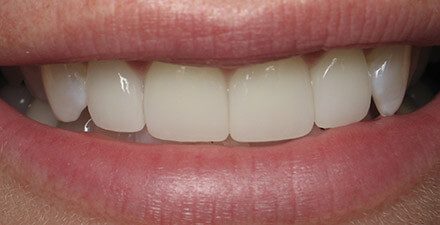 Close up of mouth with evenly sized and shaped teeth