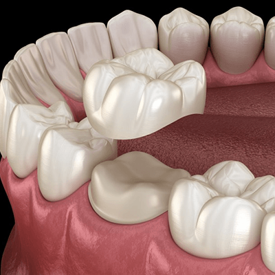 a 3D digital rendition of a dental crown