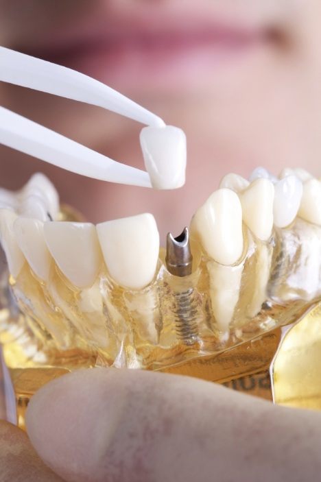 Dentist placing a dental crown on a model of dental implants in Millis