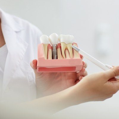 Dentist pointing to a dental implant model