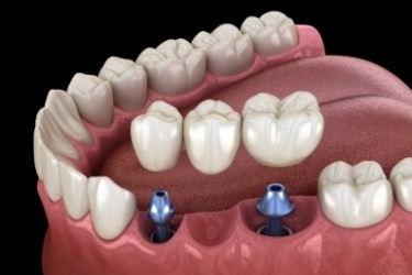 Two animated dental implants with a dental bridge