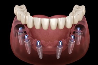 Six animated dental implants with a full implant denture