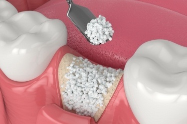 Animated dental bone grafting material being placed in jawbone where tooth is missing