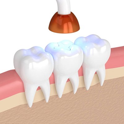 Model of a dental light hardening a filling