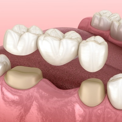 Animated dental bridge replacing a missing tooth in Millis