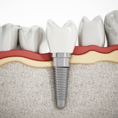 Animated dental implant with dental crown replacing a missing lower tooth