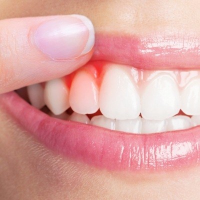 Close up of person pointing to their red gums