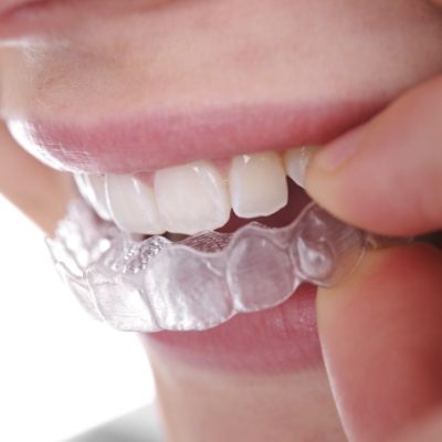 Close up of person placing Invisalign clear aligner over their teeth