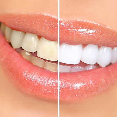 Close up of smile split down the middle showing before and after at home teeth whitening