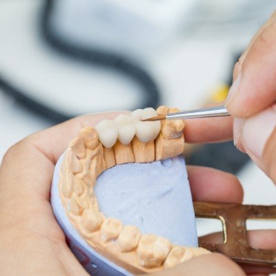 Cosmetic dentist designing an all ceramic dental restoration