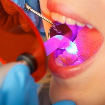 Close up of a patient receiving cosmetic dental bonding