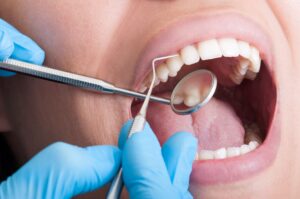 Closeup of a mouth undergoing an oral examination